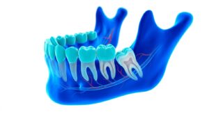 사랑니의 위치와 구조를 보여주는 의학적 3D 일러스트