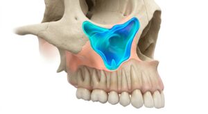 상악동 해부학적 구조와 잇몸뼈 높이의 상관관계 3D 일러스트